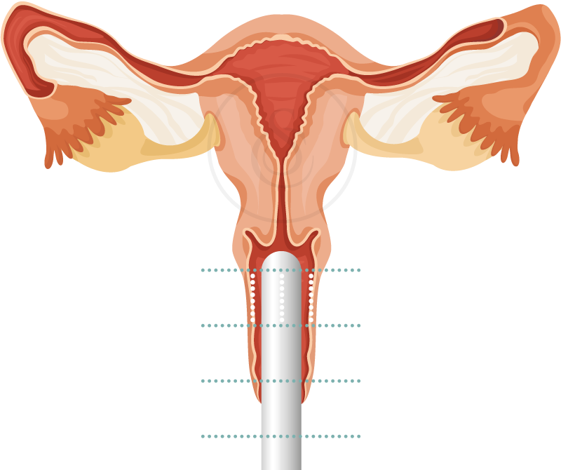 HIFU Vaginal Treatment WellnessVibes Multi Speciality Clinic in Bangalore