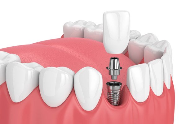 Periodontist and oral implantation​