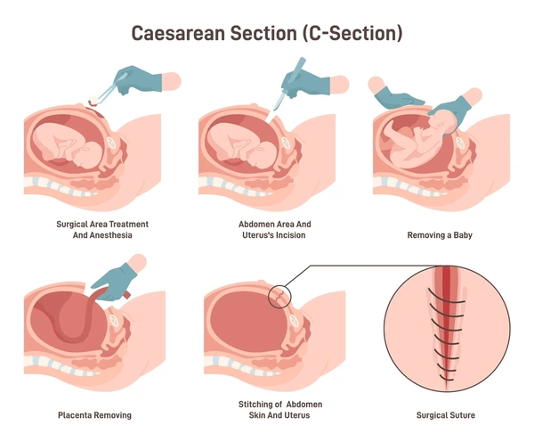 Caesarean Section - caesarean meaning -lower segment caesarean section-how many caesareans can a woman have wellnessvibes clinic bangalore