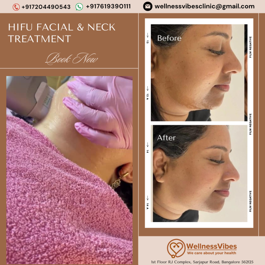 HIFU Facial and Neck Treatment in Bangalore