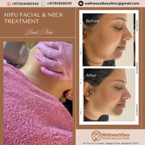 HIFU Facial and Neck Treatment in Bangalore