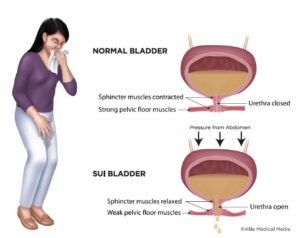 Urinary Incontinence Treatment In Sarjapur Road